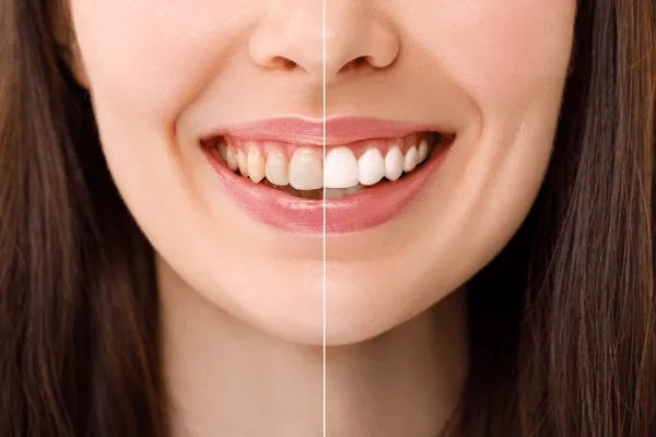teeth whitening in downtown toronto