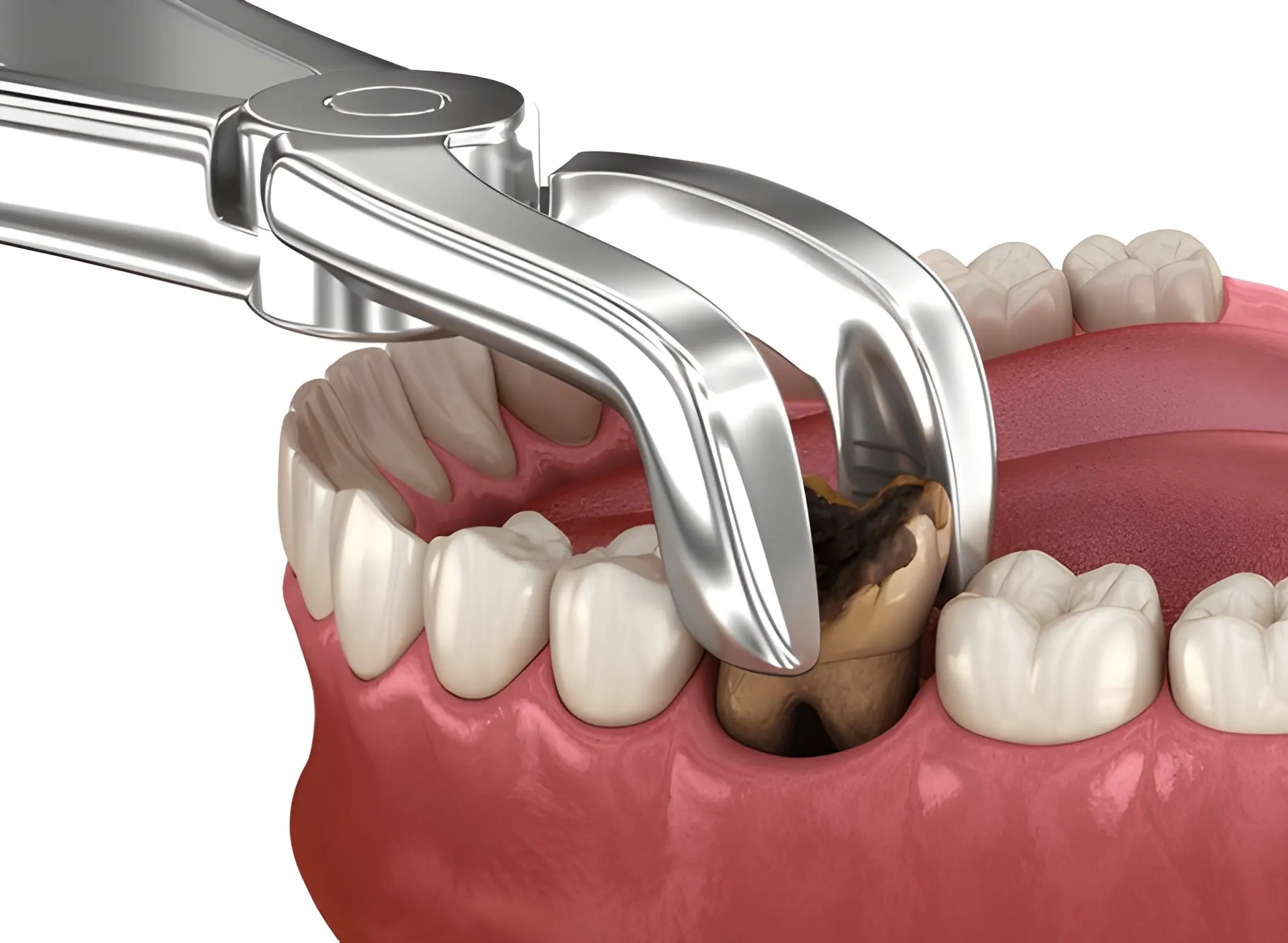 tooth extractions near you