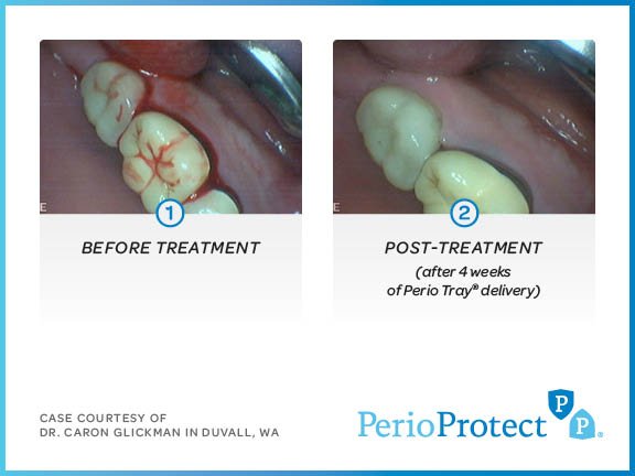 perio protect case studies10