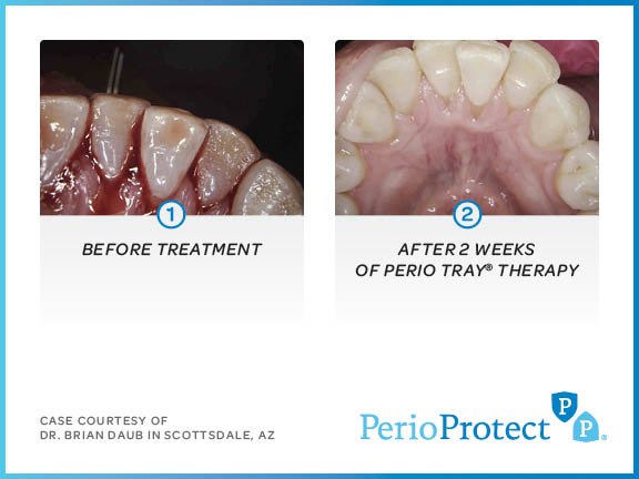 perio protect case studies5