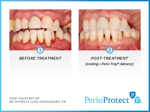 perio protect case studies9