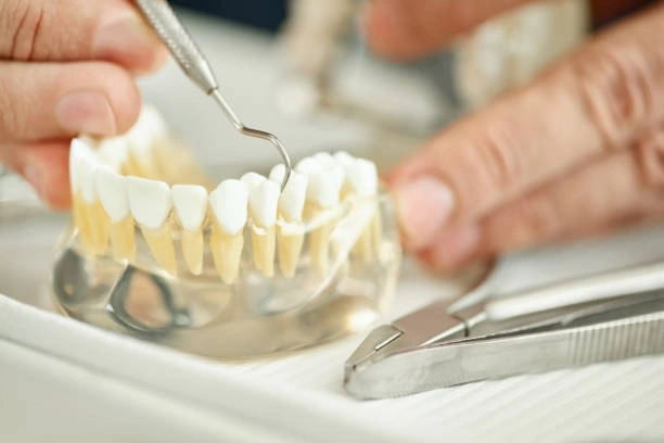 dental-crowns-and-bridges-ottawa-ontario