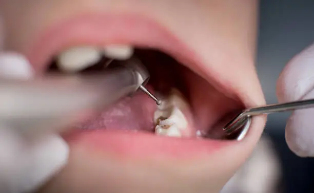 dental-fillings-near-you