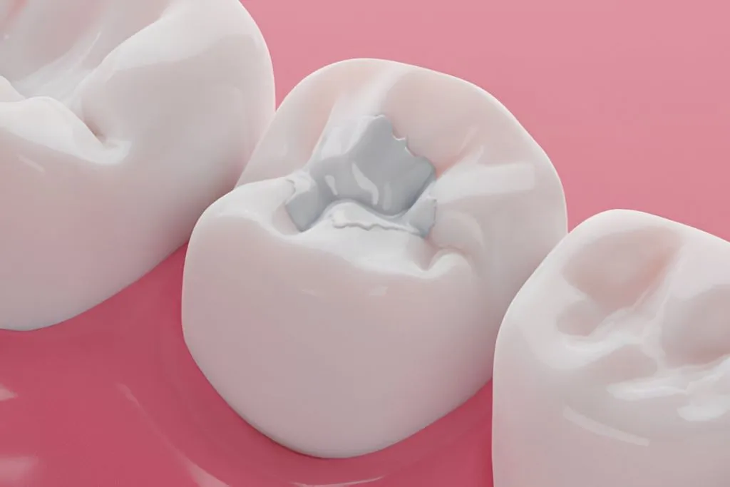 dental-fillings-ottawa