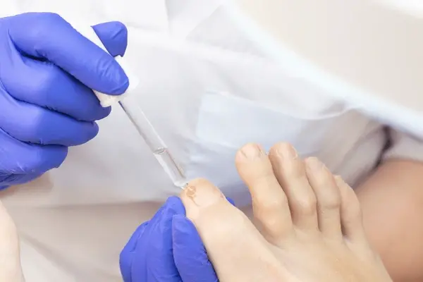 chemical nail treatment in austral, nsw