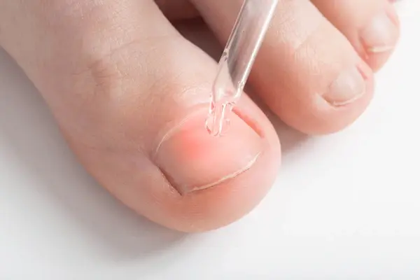 chemical nail treatment near you