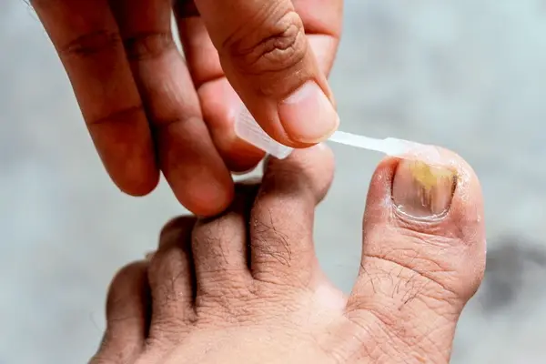 ongoing fungal nail care in austral, nsw