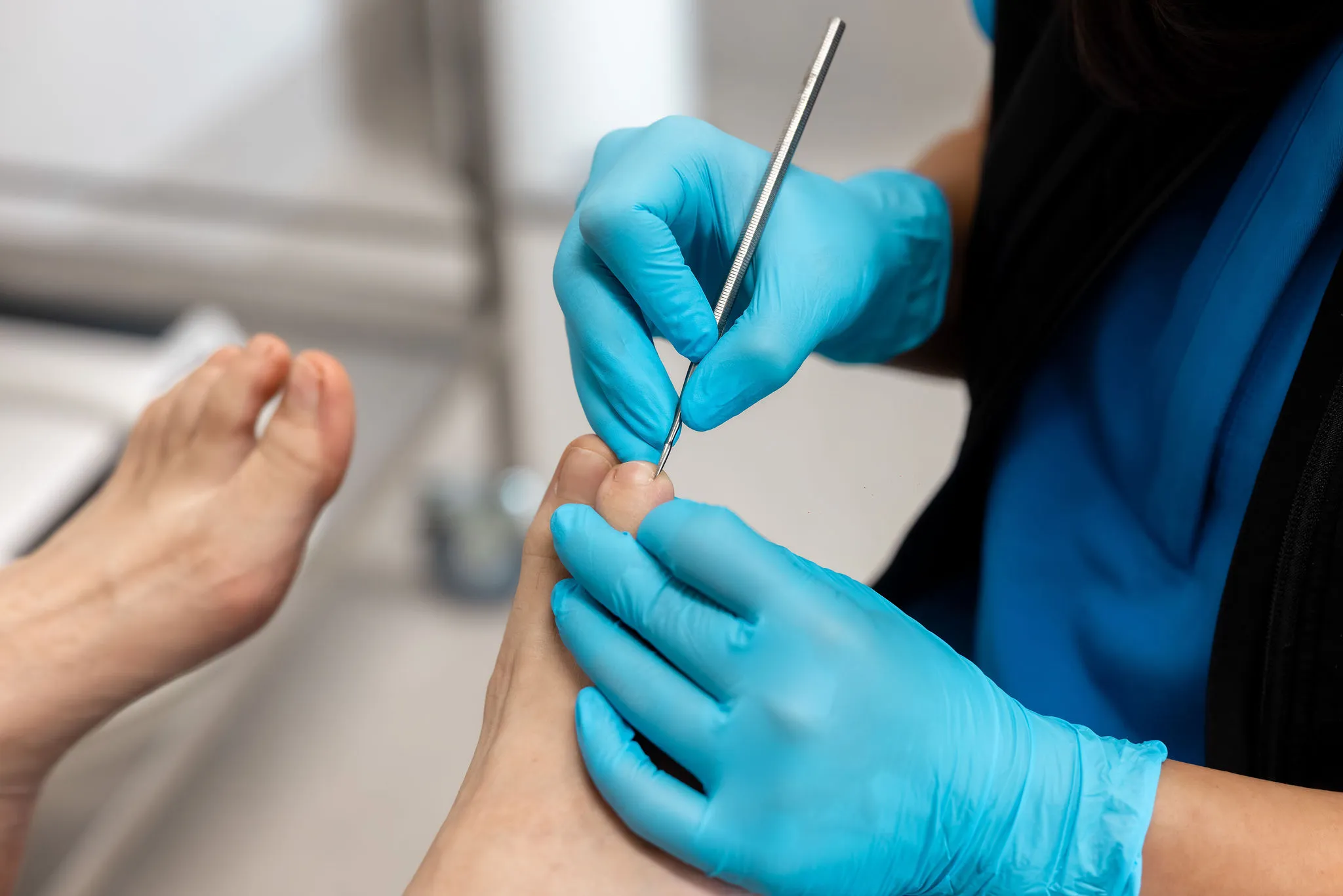 tinea pedis treatment near you