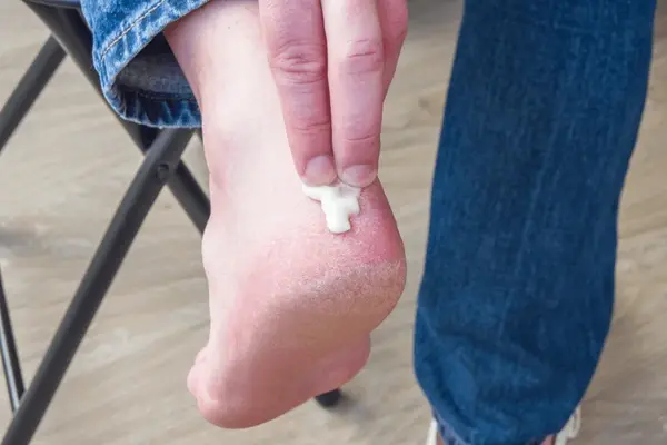 ulcer prevention near you