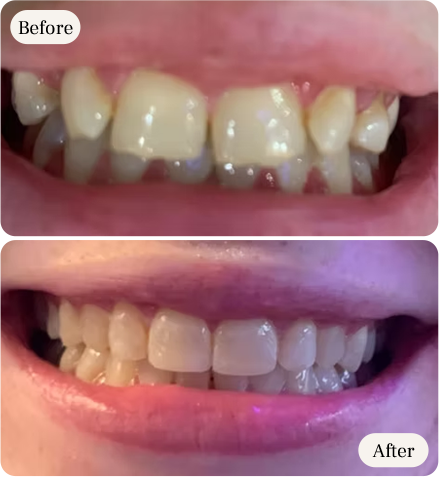 cosmetic teeth alignment before and after at dental clinic in mississauga