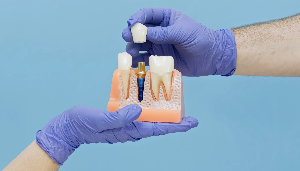 dental implants in mississauga