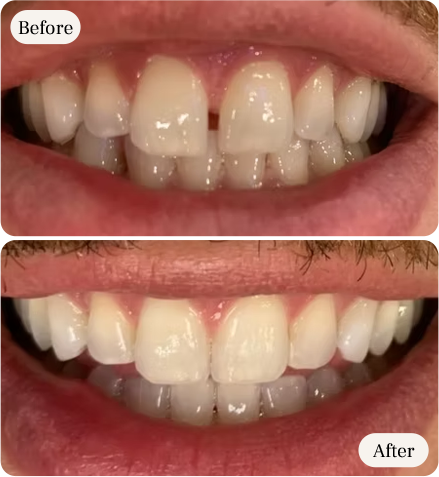 gap closure smile design before and after by dentist near you