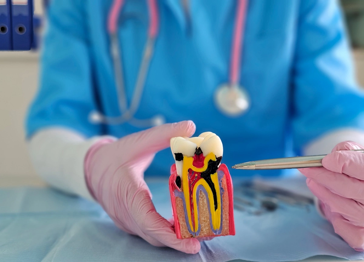root canal therapy in mississauga