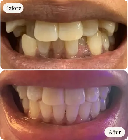 teeth straightening transformation before and after at dental clinic near you
