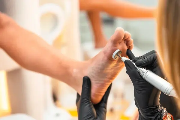 callus treatment near you