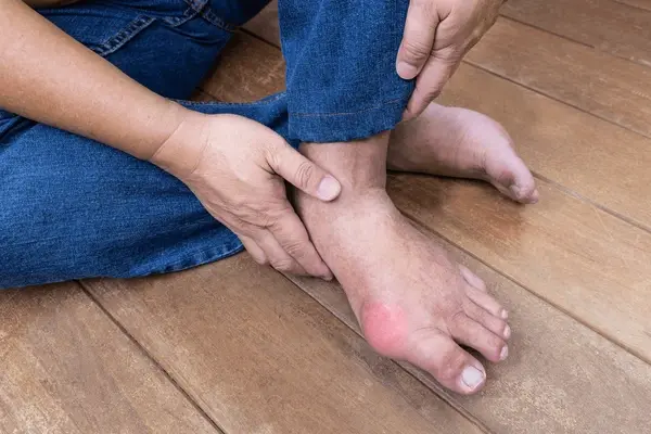 gout treatment in chino hills ca