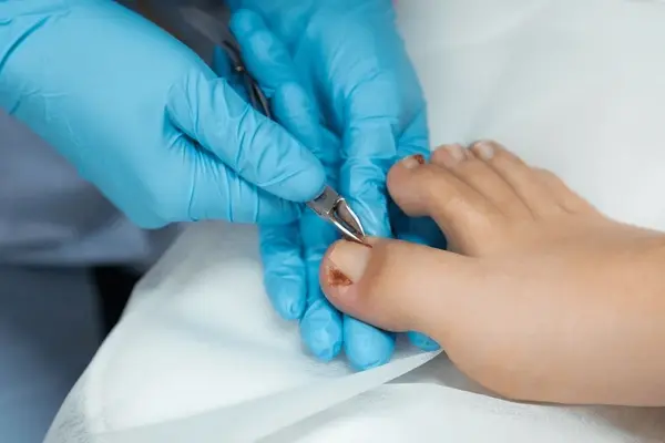 ingrown toenail treatment in chino hills ca