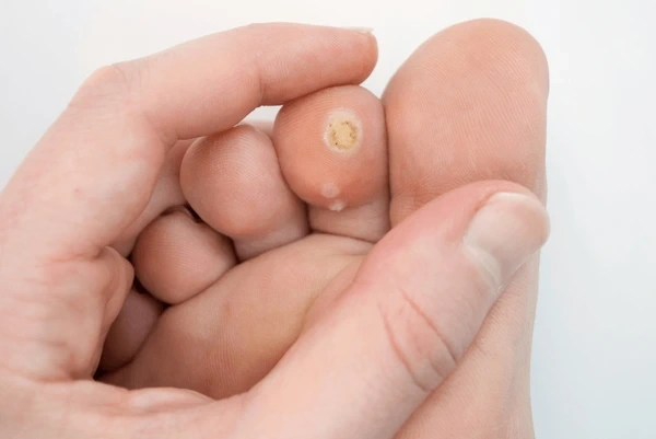 plantar wart treatment in chino hills ca