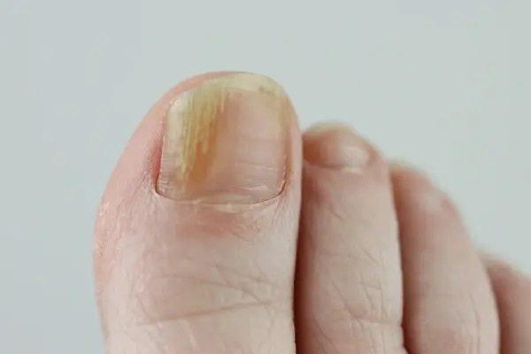 toenail fungus treatment in chino hills ca