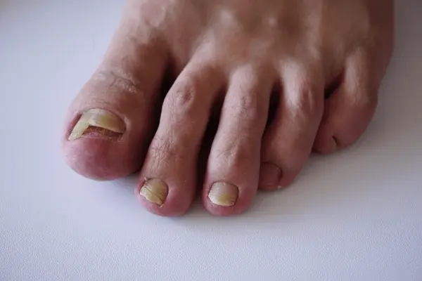 toenail fungus treatment near you