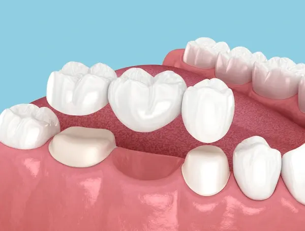 dental bridges in hamilton on