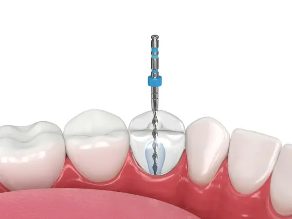root canal therapy near you