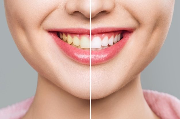 safest way to whiten your teeth
