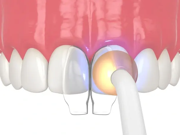 dental bonding in leduc, ab