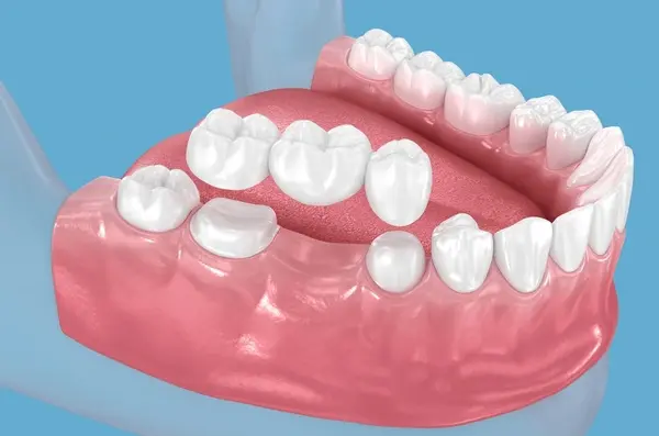 dental bridges near you