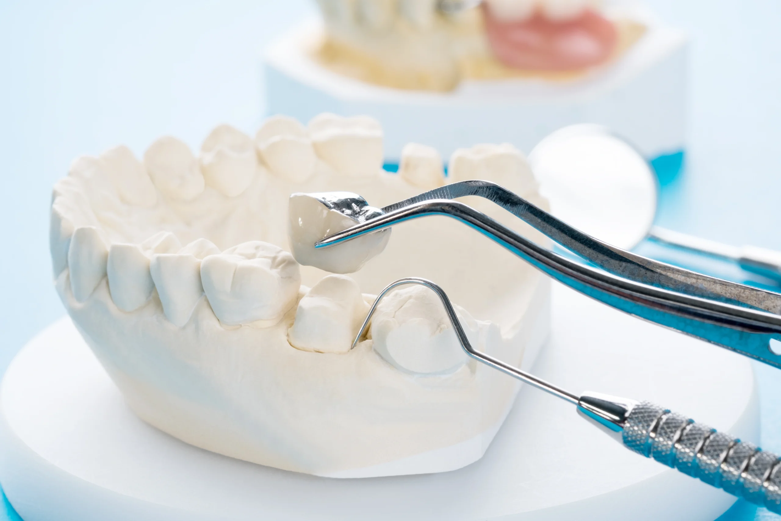 dental crowns in leduc, ab