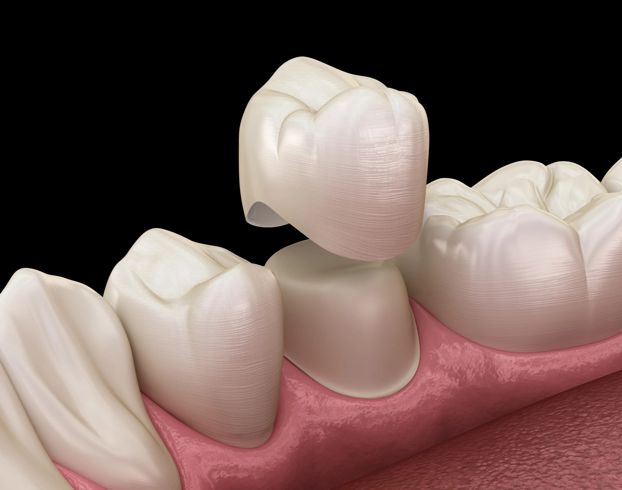 dental crowns near you