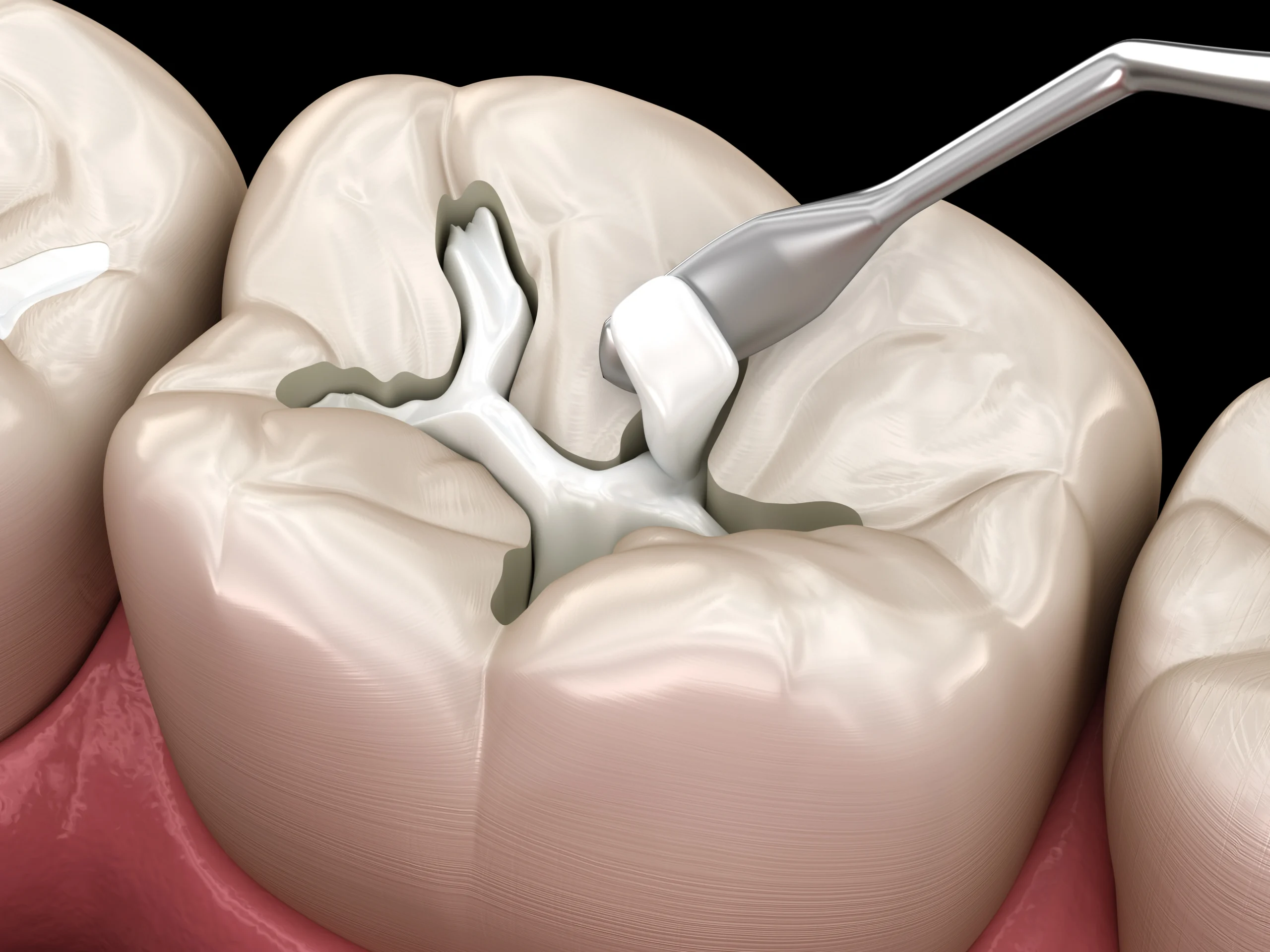 dental fillings in leduc, ab