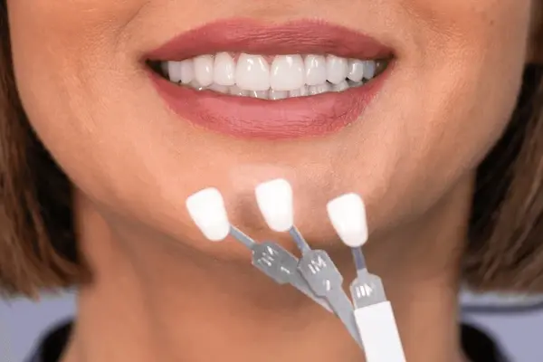 dental veneers in leduc, ab