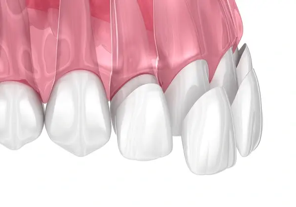 dental veneers near you