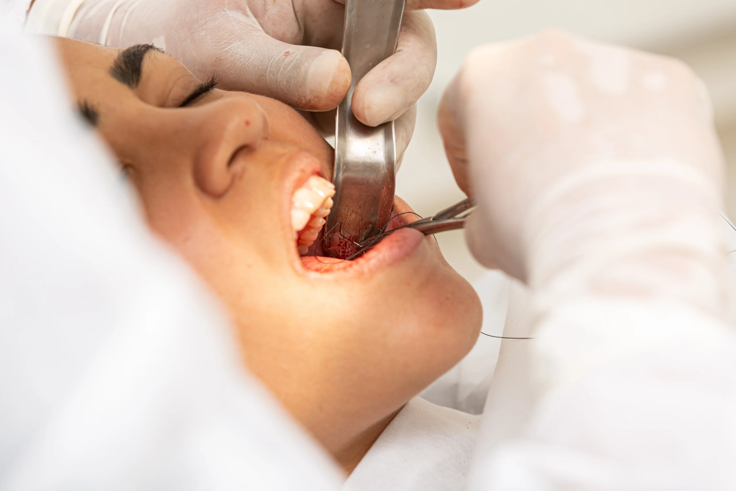 wisdom tooth extraction near you