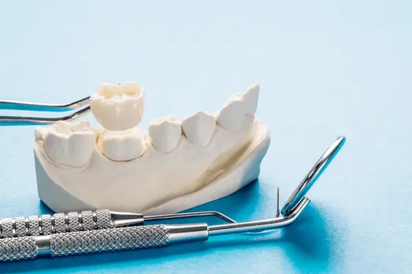 dental crowns in downtown markham