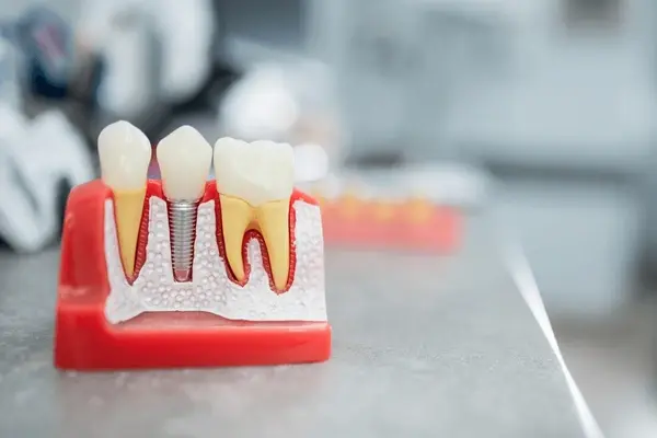 dental implants in downtown markham