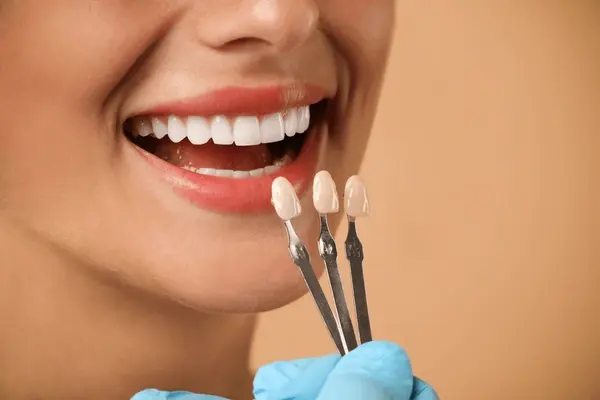dental veneers near you
