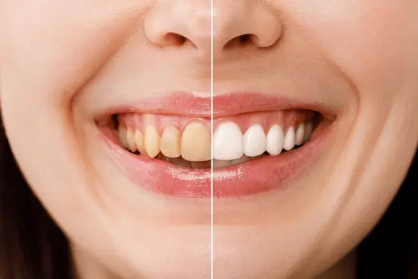 teeth whitening in downtown markham