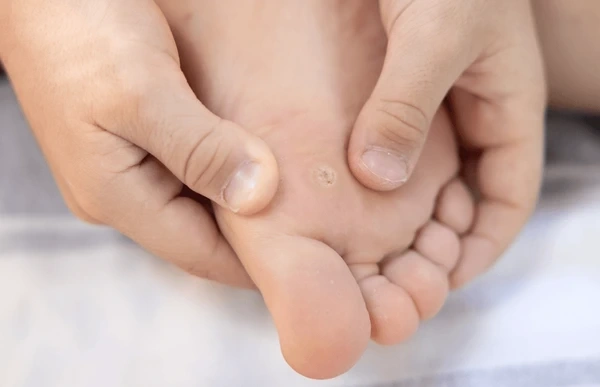 corn and callus treatment in upland, ca