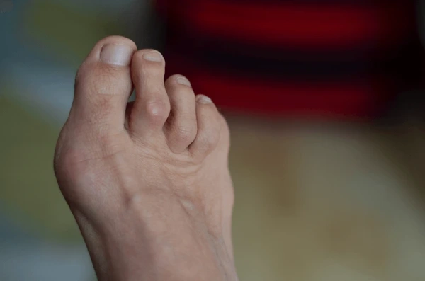 hammertoe treatment in upland, ca