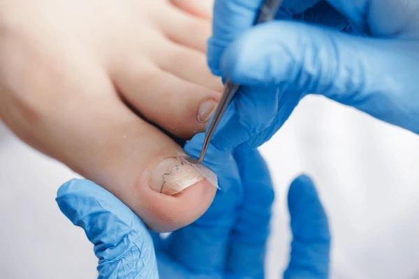 ingrown toenail treatment in upland, ca