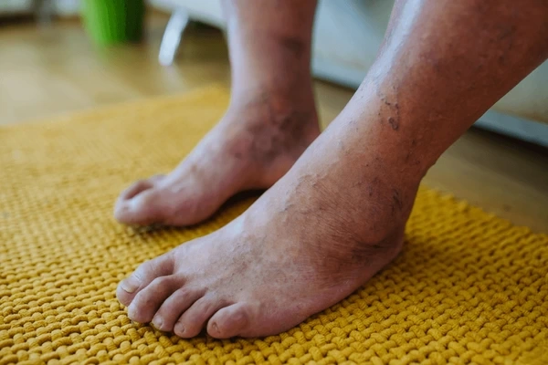 treatment for diabetic foot conditions near you