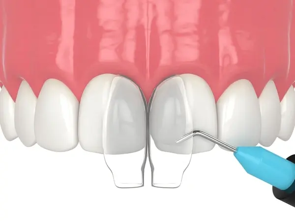 composite bonding near you