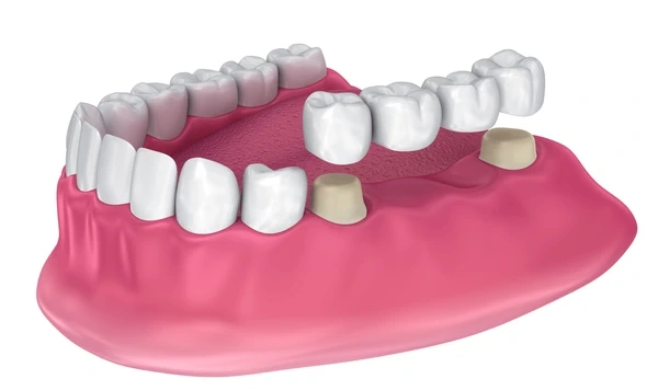 dental bridges near you