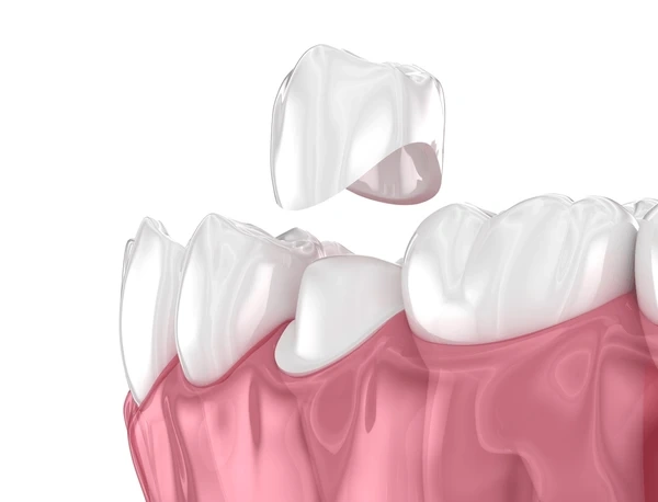dental crowns near you