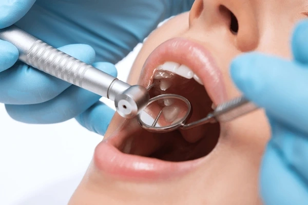 dental fillings in mississauga on