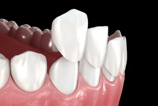dental veneers near you