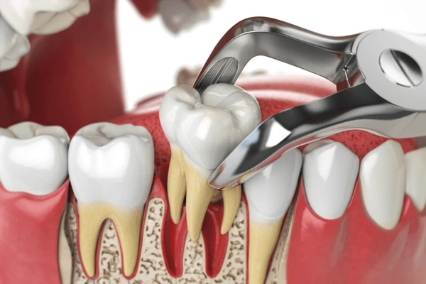 wisdom tooth extraction in mississauga on