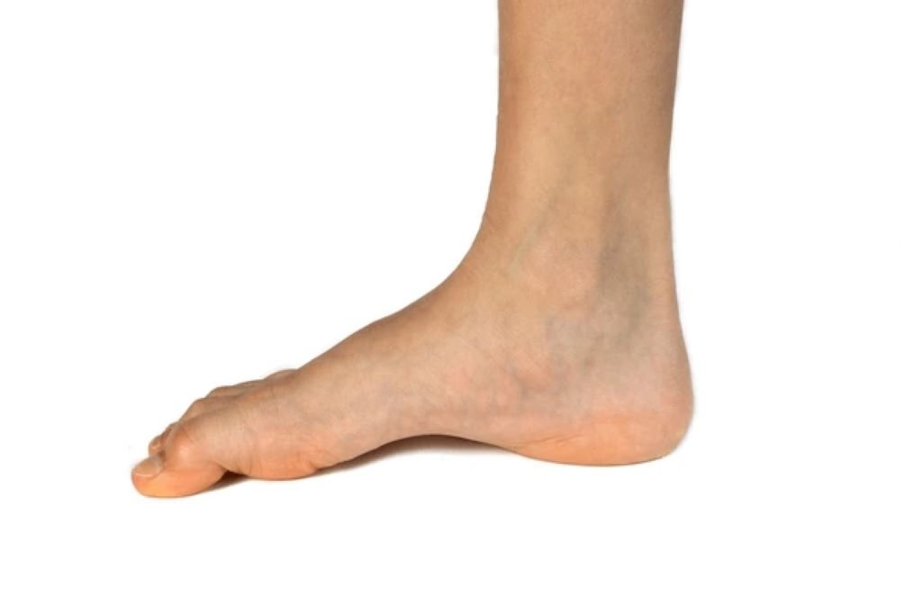 high arch foot treatment in valrico fl